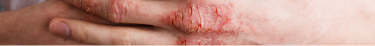 Understand Eczema Page Banner